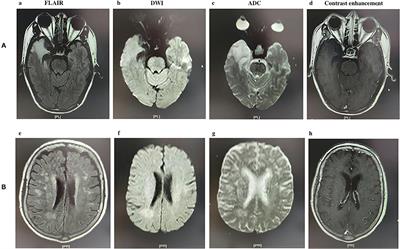 Abnormal Brain MRI Findings in Anti-N-Methyl-D-Aspartate Receptor Encephalitis and Correlation With Outcomes